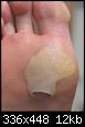     

:	plantar blister.jpg
:	3
:	12.3 
:	359639